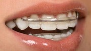 Looking for the Best Invisalign Retainers?