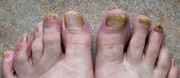Antifungal Foot Care Serum  Scientific- https://tinyurl.com/fhtdc8w